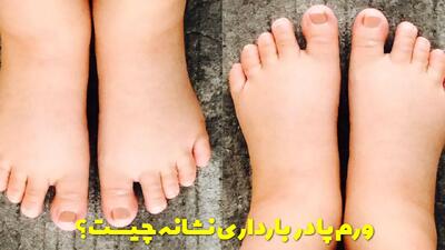  ورم پا در بارداری نشانه چیست و چه زمانی خطرناک است؟