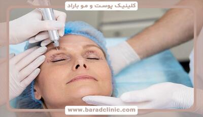  عوارض بلفاروپلاستی و راهکارهای پیشگیری | هر آنچه قبل و بعد از جراحی پلک باید بدانید - سلام نو