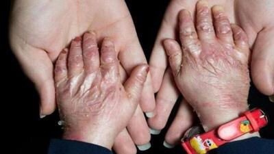  خانه‌ای‌بی؛ تداوم خدمت به بیماران پروانه‌ای در روز‌های اختلال ارتباطات