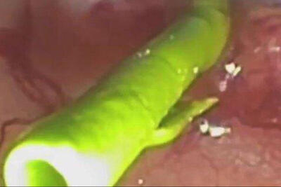  پیوند شگفت‌انگیز آهن و انسولین