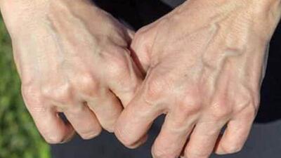  چرا رگ‌ها زیر پوست برخی افراد می‌درخشند؟