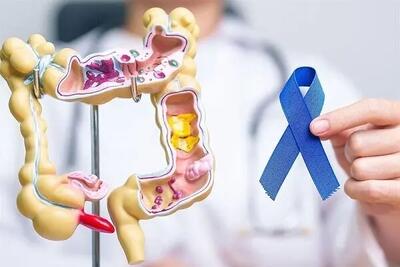  یافته‌های جدید درباره پیشگیری از سرطان روده