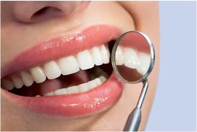  هزینه کامپوزیت دندان در سال 1404 چقدر است؟