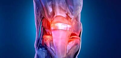  آرتروز دیگر بیماریِ سنین بالا نیست