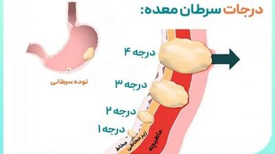  میگنا - علت اصلی سرطان معده و نحوه تشخیص آن