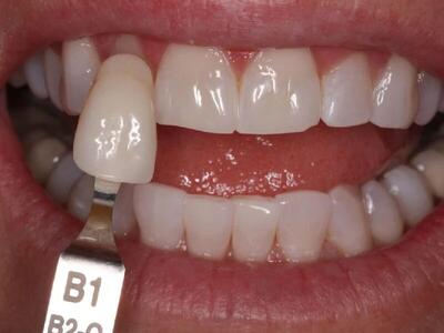  کامپوزیت دندان چیست؟ قیمت کامپوزیت دندان در تهران ۱۴۰۴