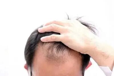  دلایل شایع ریزش مو