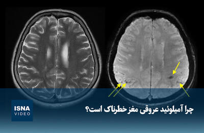  ویدیو/ چرا آمیلوئید عروقی مغز خطرناک است؟