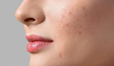  این مواد غذایی باعث بروز آکنه و جوش می‌شوند