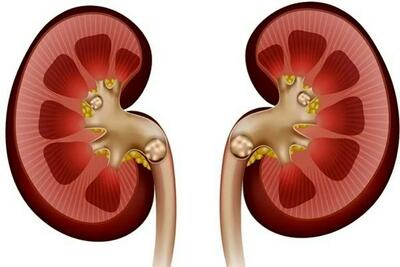  فشار خون بالا چه بلایی سر کلیه‌ها می‌آورد؟