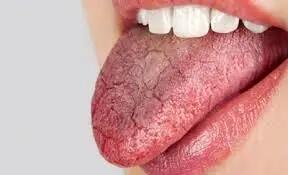  راهکارهای علمی برای تسکین خشکی دهان + اینفوگرافی