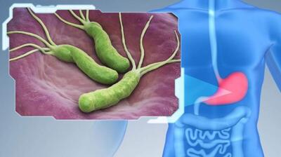  میگنا - هلیکوباکتر پیلوری عفونتی که معده را تخریب می‌کند