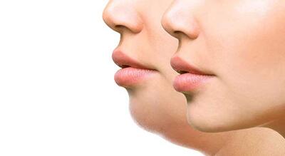  ساکشن غبغب: روش سریع و موثر برای رفع چربی‌های اضافی و داشتن ظاهری جوان‌تر!