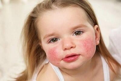  رازهای شکل‌گیری «حساسیت غذایی» در کودکان