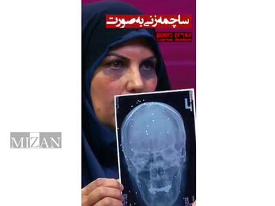 شاهد عینی از ساچمه‌زنی به صورت: ۲۵۰ ساچمه به چشم و صورتم خورد؛ کسی که به من شلیک کرد، تروریست بود