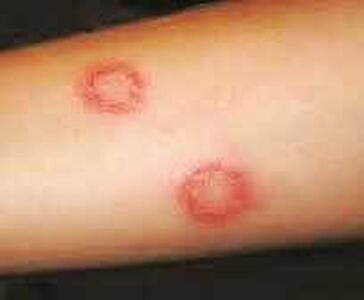  ابتلای ۴۸۰۰ نفر به سالک در سال جاری