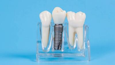  بررسی اجمالی انواع خدمات ایمپلنت دندان و مقایسه قیمت‌های آن