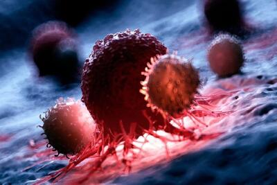  «کشف توده» یا «غربالگری»؟ نقد سیاست‌های تشخیص سرطان در کشور