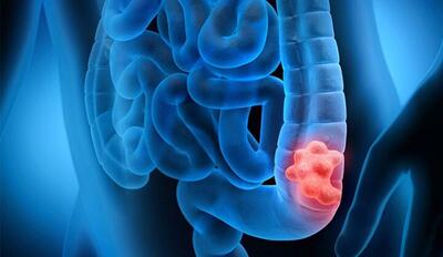  افزایش چشمگیر خطر ابتلا به سرطان روده بزرگ با مصرف مشروبات الکلی