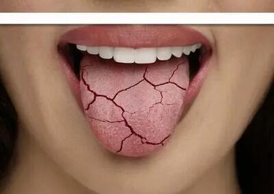  ۱۰ راه ساده برای خلاص شدن از خشکی دهان