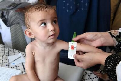  یارانه کودکان دارای سوء تغذیه + راهنمای دریافت - مجله اینترنتی کولاک