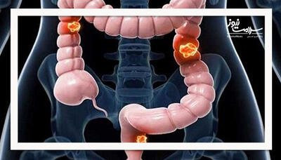  سرطان روده بزرگ؛ بررسی علل شیوع بیشتر در جوانان، علائم و نکات پیشگیری