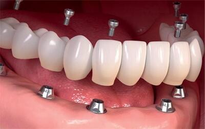  افزایش استقبال بیماران از روش اوردنچر در درمان بی‌دندانی کامل