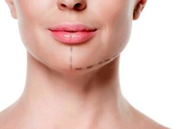  راهنمای کامل لیفت میدفیس بدون جراحی + بررسی مزایا و معایب