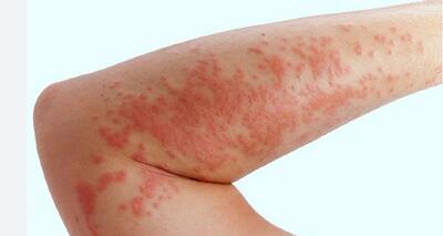  درمان کهیر در طب سنتی