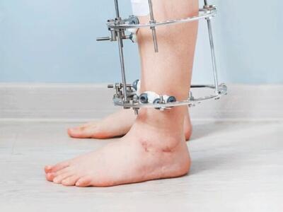  جراحی‌های افزایش قد چقدر موثر است؟