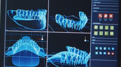  قبل از کاشت دندان این تفاوت مهم را بدانید! - مردم سالاری آنلاین