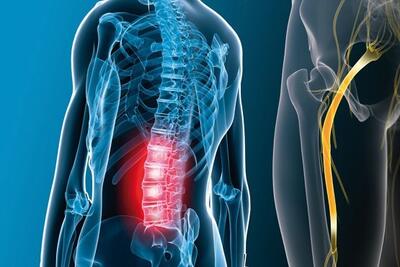  «سیاتیک» چگونه درمان می‌شود؟