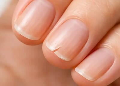  علت شکنندگی ناخن‌ ها چیست؟ بررسی دلایل و راه‌های درمان قطعی