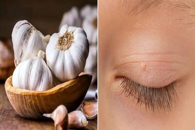  از بین بردن اسکین تگ همان منگوله پوستی ؛ بدون هزینه برای لیزر با مواد طبیعی و در خانه