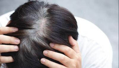  نشانه احتمالی ابتلا به پارکینسون در موها پنهان است