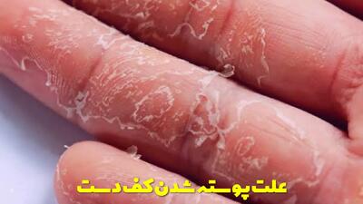  علت پوسته شدن کف دست چیست؟ + روش های جلوگیری از آن
