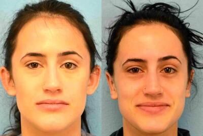  بهترین جراح زیبایی گوش در تهران + لیست 10 جراح برتر