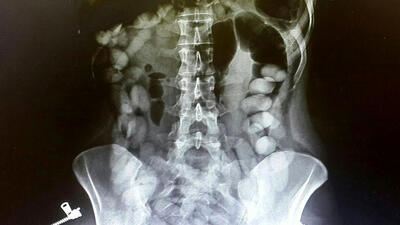  کشف یک کیلو کوکائین از شکم مسافری در فرودگاه امام‌خمینی (ره)