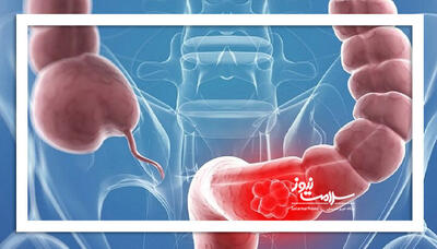  این تغذیه خطر ابتلا به سرطان روده را افزایش می‌دهد