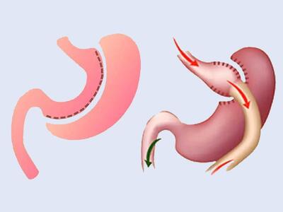  عمل اسلیو معده یا عمل بای پس معده؛ کدام روش کاهش وزن موثرتر است؟