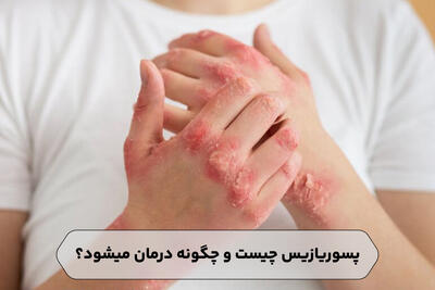  پسوریازیس چیست و چگونه درمان میشود؟