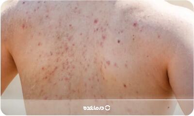  علت جوش کمر در زنان و مردان چیست؟