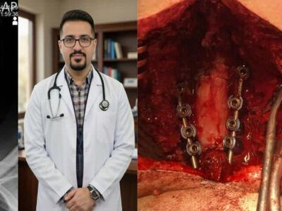  نجات بیمار در آستانه فلج با جراحی پیچیده دو مرحله‌ای در سنندج