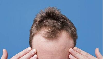  کدام ریزش مو در مردان شایع‌تر است؟