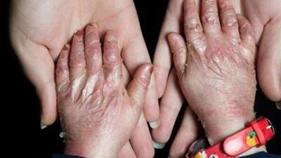  تقویت حمایت‌های هدفمند و خدمات تخصصی از بیماری‌های نادر در اولویت است