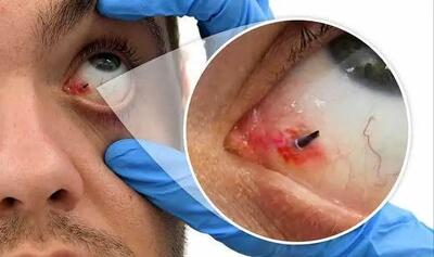  در زمان تروما یا ضربه به چشم در اثر انفجار چه باید کرد؟