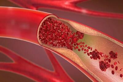  روش‌های اورژانسی پیشگیری از خونریزی در مجروحان