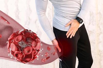  لخته شدن خون در پا چه خطراتی دارد؟ از عوارض مزمن تا مرگ ناگهانی