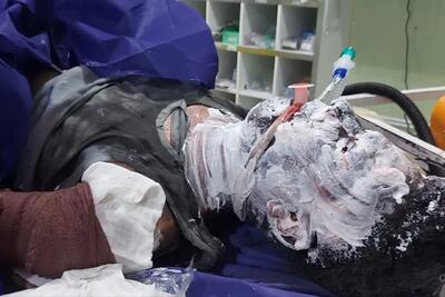  اورژانس: ۷۲ نفر براثر انفجار مواد محترقه مرتبط با چهارشنبه سوری مصدوم شدند