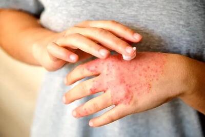  علت تشدید اگزما در نتیجه استرس کشف شد